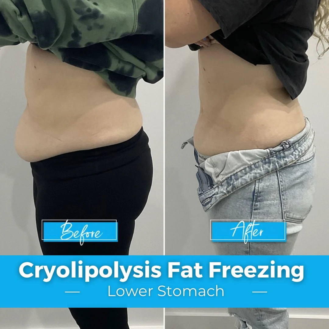 CoolSculpting
